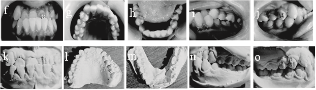 Intraoral photographs and study models for Case 1