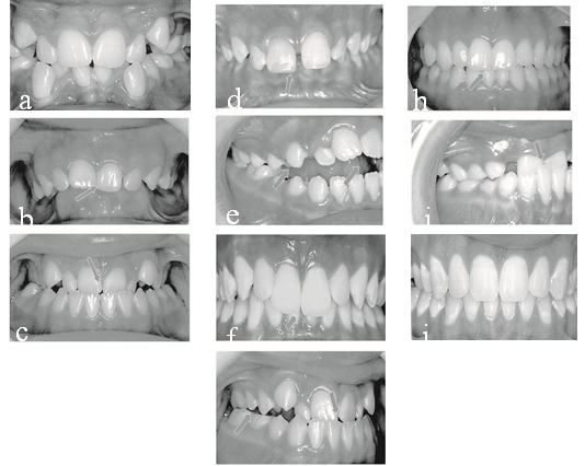 Figure 1: Malocclusion and IOTN grades