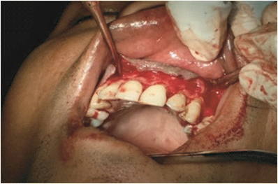 Fig 1: Extension of Flap