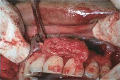 Fig 2: Removal of infected Cyst