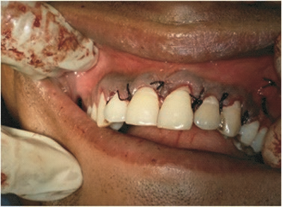 Fig 3: Repositioning of flap with suture