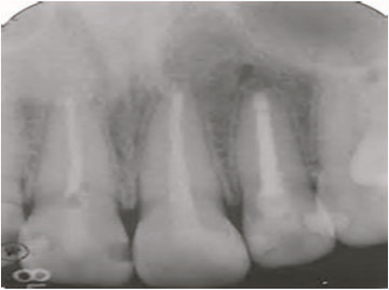 Fig 4: Obturation of the Root Canal