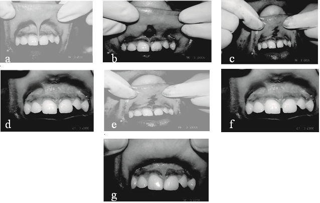 Figure 1: Procedure of frenectomy