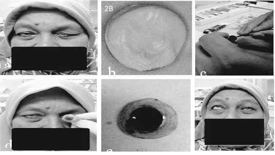 Figure 1: Case photographs of ocular prosthetic rehabilitation