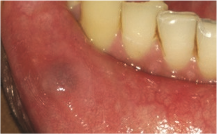 Figure 1b: Mucocele in lower lip