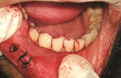 Figure 2: After excision