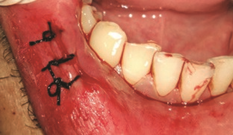 Figure 2: After excision